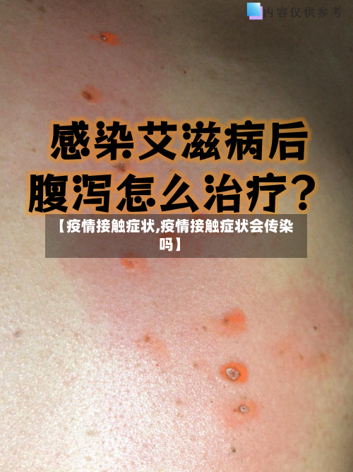 【疫情接触症状,疫情接触症状会传染吗】-第2张图片