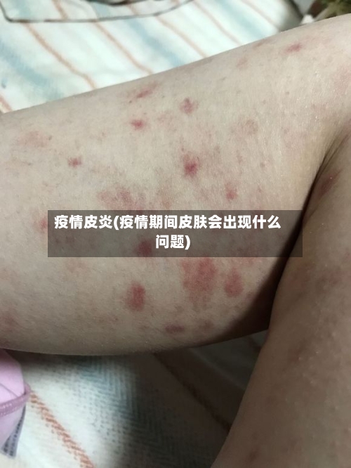 疫情皮炎(疫情期间皮肤会出现什么问题)-第2张图片