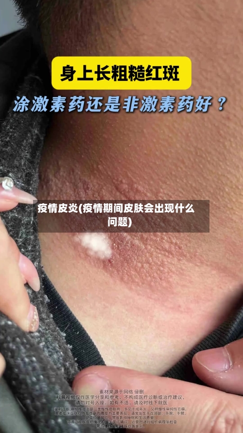 疫情皮炎(疫情期间皮肤会出现什么问题)-第3张图片
