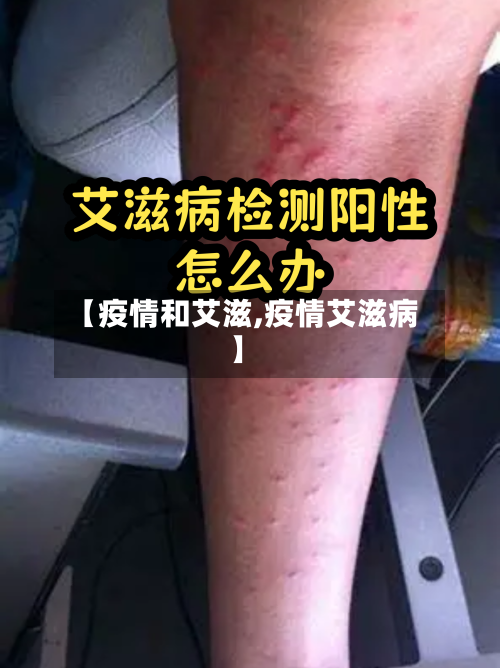 【疫情和艾滋,疫情艾滋病】
