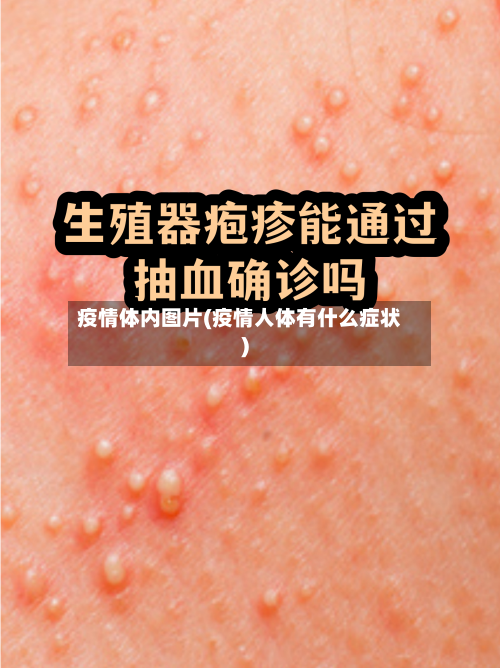 疫情体内图片(疫情人体有什么症状)-第2张图片