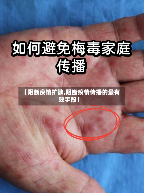 【阻断疫情扩散,阻断疫情传播的最有效手段】-第2张图片