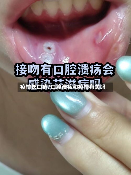 疫情长口疮/口腔溃疡和疫情有关吗