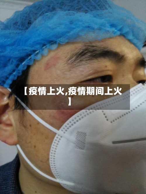 【疫情上火,疫情期间上火】-第3张图片