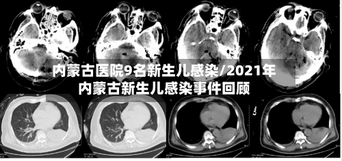 内蒙古医院9名新生儿感染/2021年内蒙古新生儿感染事件回顾-第3张图片